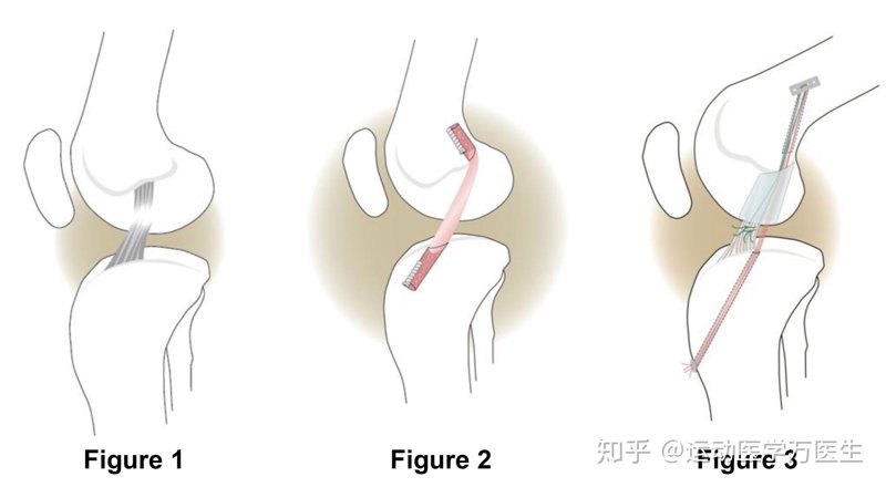 康复训练：重启生命活力的阶梯